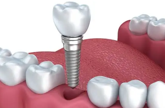 缺了颗牙，必须做种植牙吗？—义乌傅氏口腔