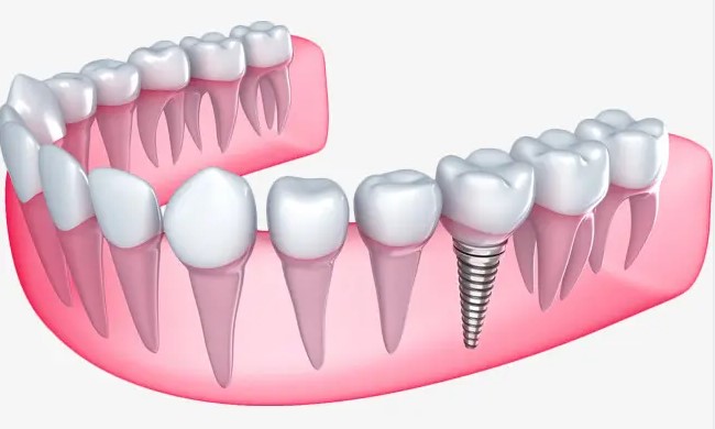 护牙不规范,牙疼真要命! 护牙不规范,牙疼真要命!