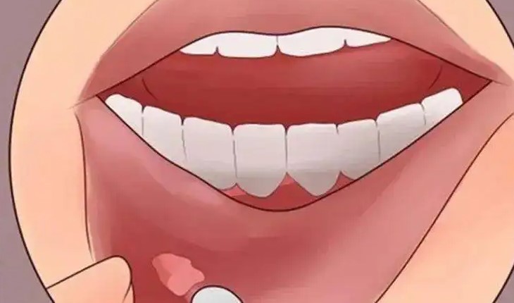 口腔溃疡为何会反复发作?—义乌傅氏口腔 口腔溃疡为何会反复发作?—义乌傅氏口腔