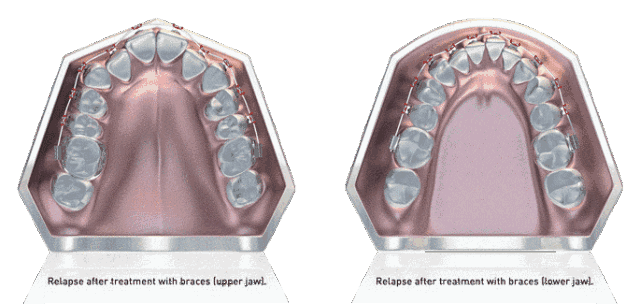 牙齿拥挤不用拔牙矫正的三种方式！—义乌傅氏口腔