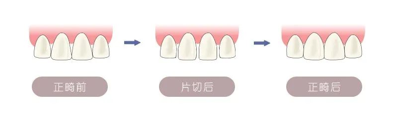 牙齿拥挤不用拔牙矫正的三种方式！—义乌傅氏口腔