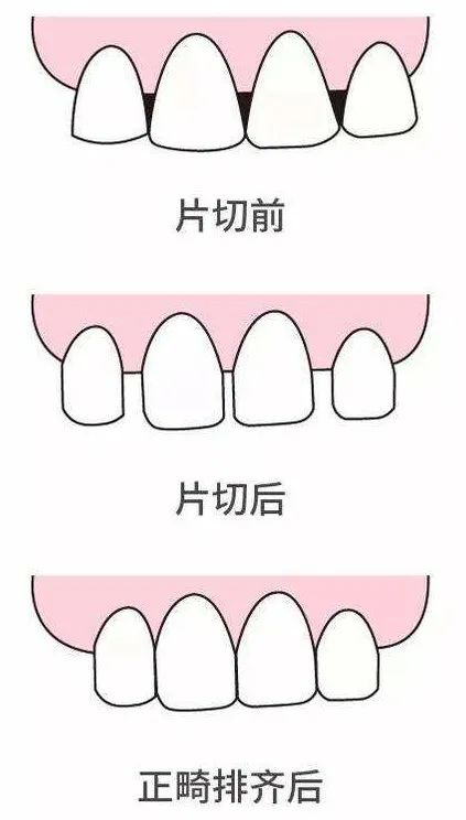 牙齿拥挤不用拔牙矫正的三种方式！—义乌傅氏口腔