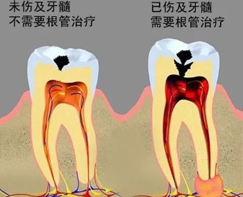 牙齿烂了一半,为何不能直接补牙? 牙齿烂了一半,为何不能直接补牙?