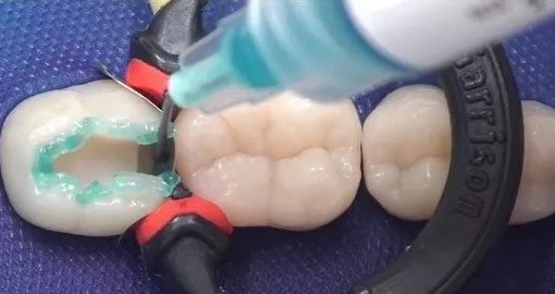 玻璃离子补牙 玻璃离子补牙