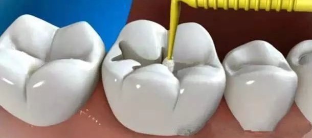 复合树脂补牙 复合树脂补牙