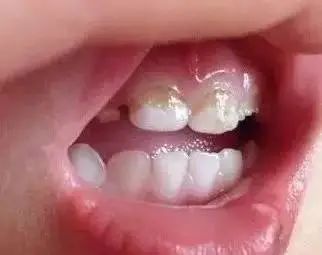 远离蛀牙，三岁以内的孩子该如何吃？—义乌傅氏口腔