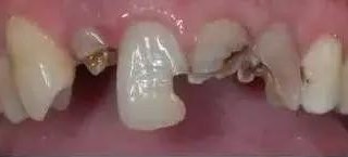 牙齿烂的剩牙根，能补救吗？