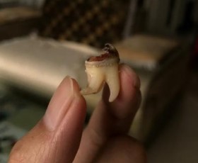 牙齿烂的剩牙根，能补救吗？