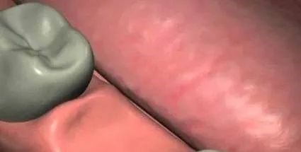 详细的种植牙流程! 详细的种植牙流程!