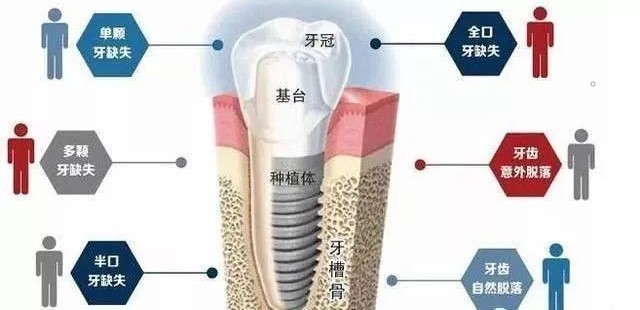 种牙流程是什么? 种牙流程是什么?