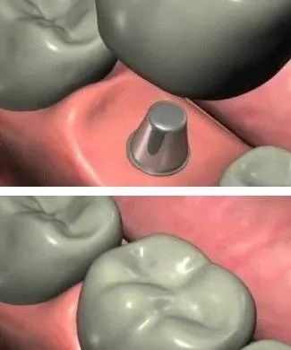 详细的种植牙流程! 详细的种植牙流程!