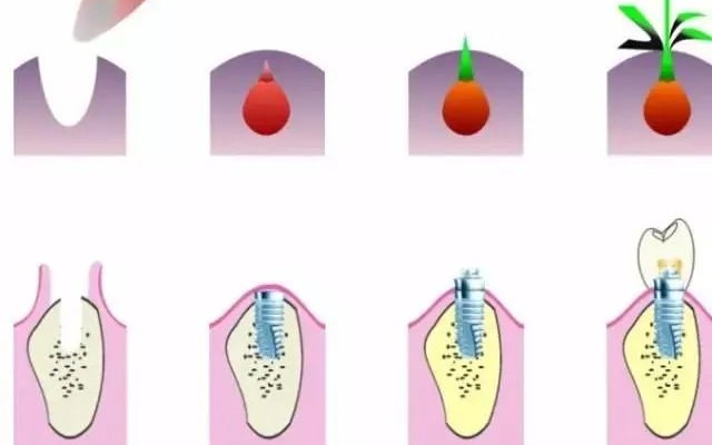 种牙流程是什么? 种牙流程是什么?