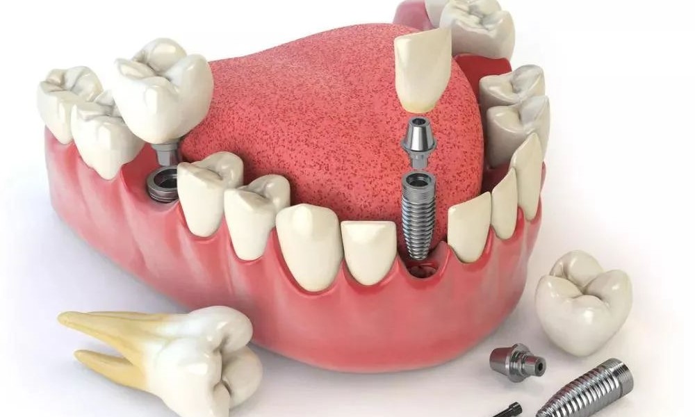 种牙流程是什么? 种牙流程是什么?