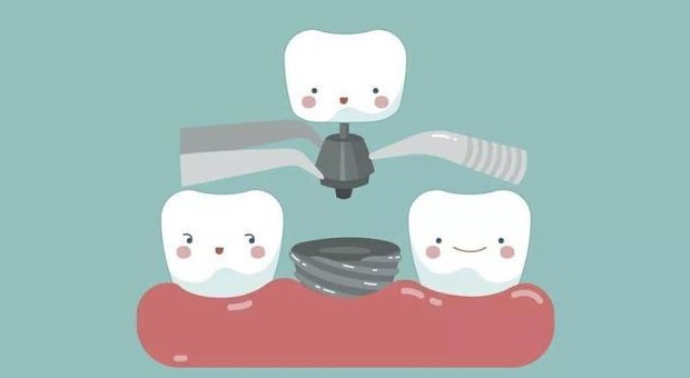 种牙流程是什么? 种牙流程是什么?