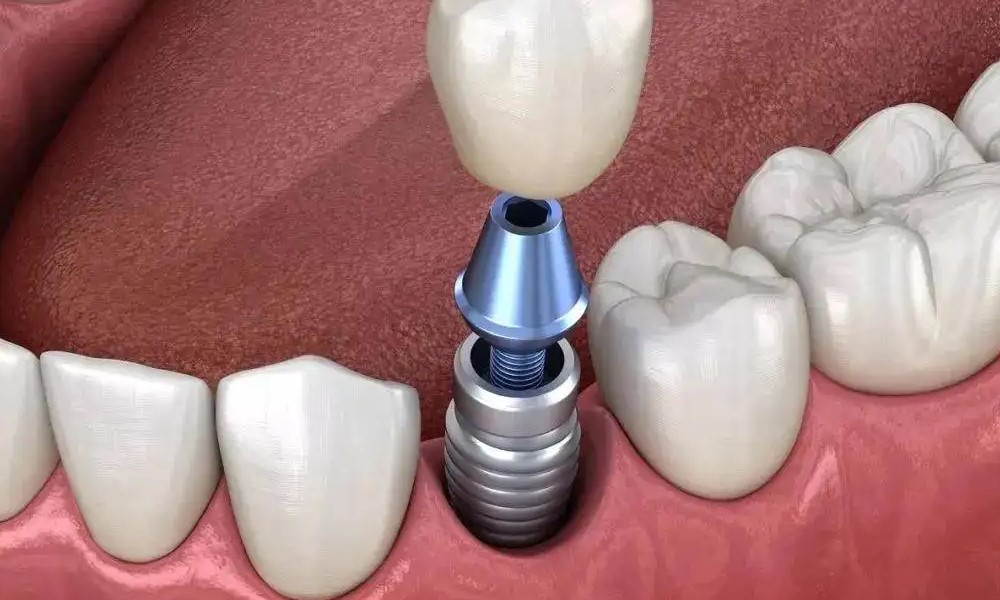 需知道的种植牙六大优势！