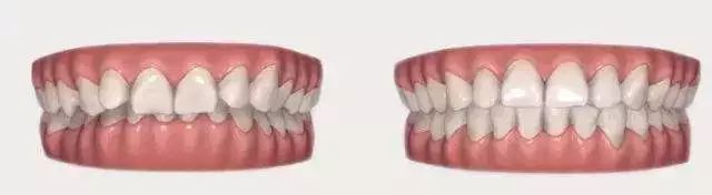 矫正牙齿，可以改变脸型吗？—义乌傅氏口腔