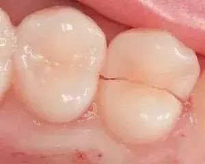 小小裂纹不在意,可能引起牙齿缺失!—义乌傅氏口腔 小小裂纹不在意,可能引起牙齿缺失!—义乌傅氏口腔