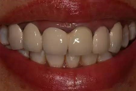 为何要少做烤瓷牙连（联）冠？