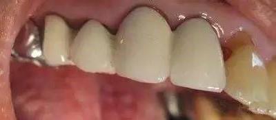 为何要少做烤瓷牙连（联）冠？