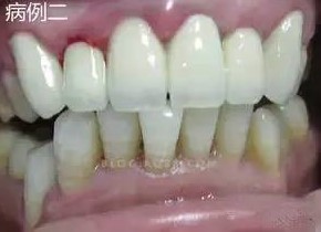 为何要少做烤瓷牙连（联）冠？