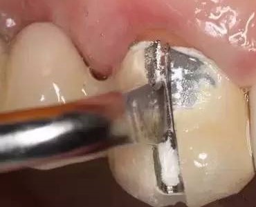 为何要少做烤瓷牙连（联）冠？