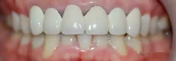 为何要少做烤瓷牙连（联）冠？