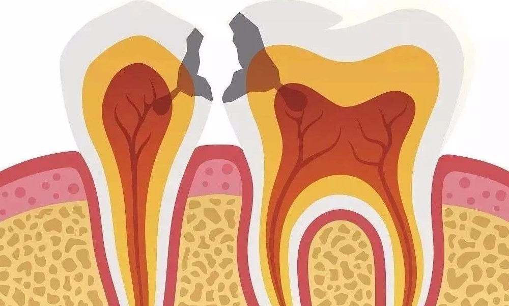 当心邻面龋,一颗坏成两! 当心邻面龋,一颗坏成两!