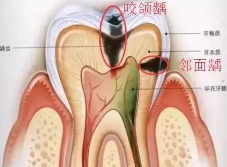 当心邻面龋,一颗坏成两! 当心邻面龋,一颗坏成两!