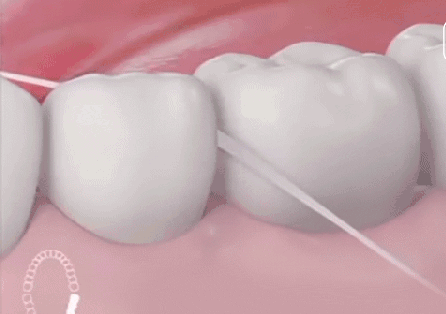 当心邻面龋,一颗坏成两! 当心邻面龋,一颗坏成两!