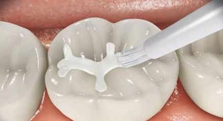 六龄牙终生不换，家长们知道吗？