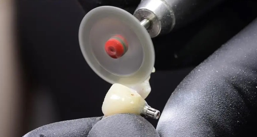 临时牙修复体,可能会忽略的细节! 临时牙修复体,可能会忽略的细节!