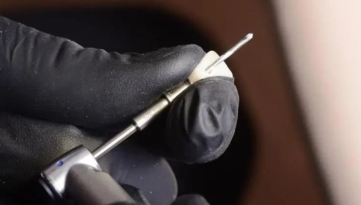 临时牙修复体,可能会忽略的细节! 临时牙修复体,可能会忽略的细节!