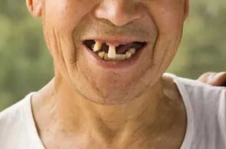 老年人常见的口腔问题及其对全身影响！—义乌傅氏口腔