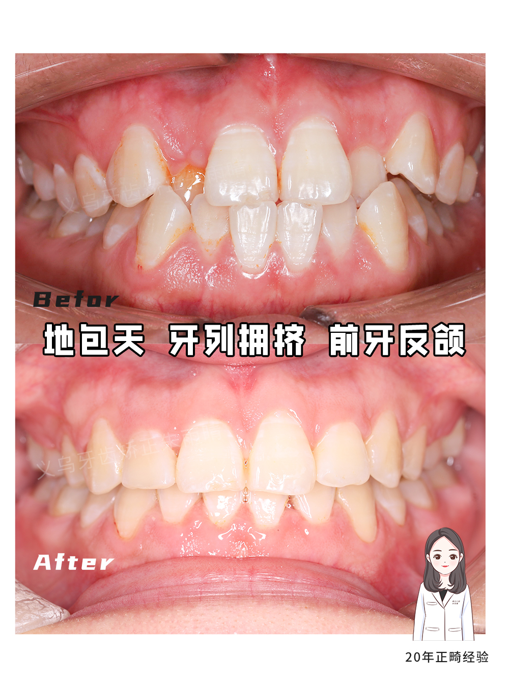 牙齿矫正对脸型有多少影响？—义乌口腔正畸