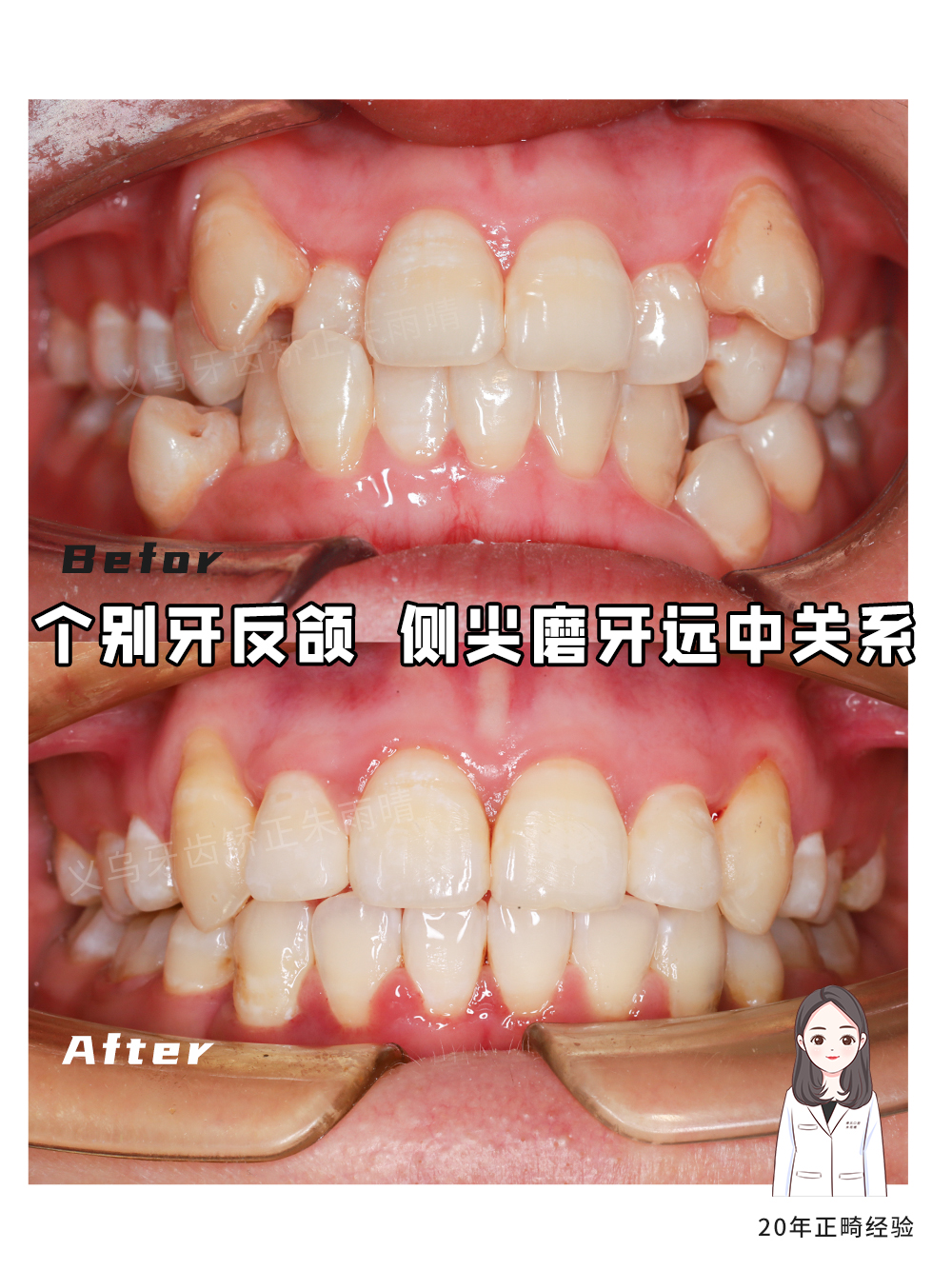 牙齿矫正对脸型有多少影响？—义乌口腔正畸