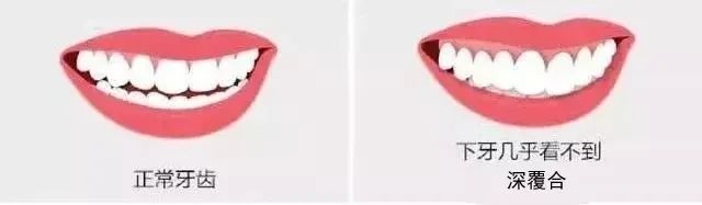 怎样的脸型牙齿矫正后会美上加美？—义乌傅氏口腔
