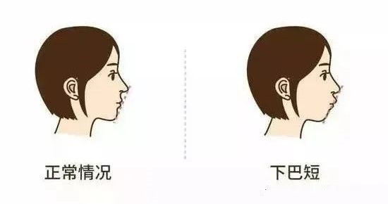 怎样的脸型牙齿矫正后会美上加美？—义乌傅氏口腔