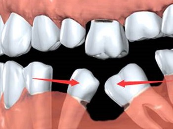 一颗牙掉了,其他牙都在做什么? 一颗牙掉了,其他牙都在做什么?