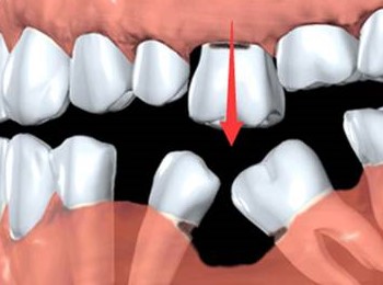 一颗牙掉了,其他牙都在做什么? 一颗牙掉了,其他牙都在做什么?
