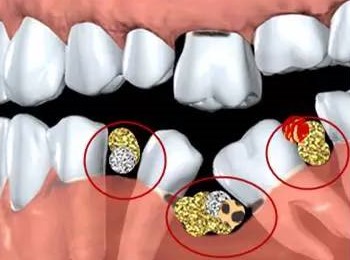 一颗牙掉了,其他牙都在做什么? 一颗牙掉了,其他牙都在做什么?