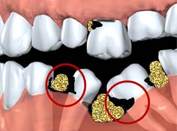 一颗牙掉了,其他牙都在做什么? 一颗牙掉了,其他牙都在做什么?