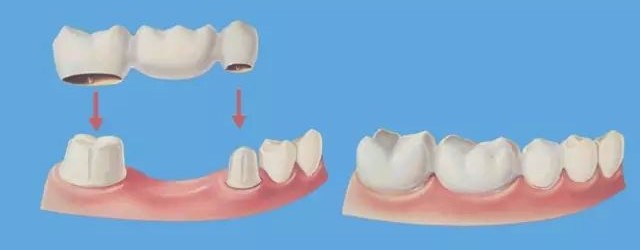 一颗牙掉了,其他牙都在做什么? 一颗牙掉了,其他牙都在做什么?