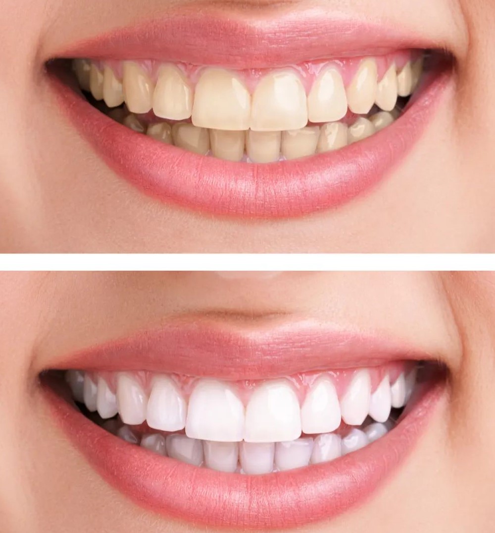 关于牙齿美白,你想知道的十个问题! 关于牙齿美白,你想知道的十个问题!