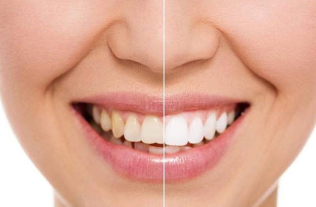 想美白牙齿，这四种方法不要错过！—义乌傅氏口腔