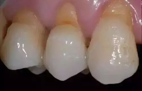 楔状缺损：牙齿根部被磨损成V形