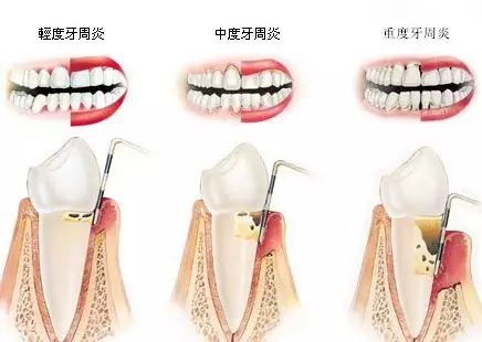 牙齿敏感到底是怎么回事？—义乌傅氏口腔