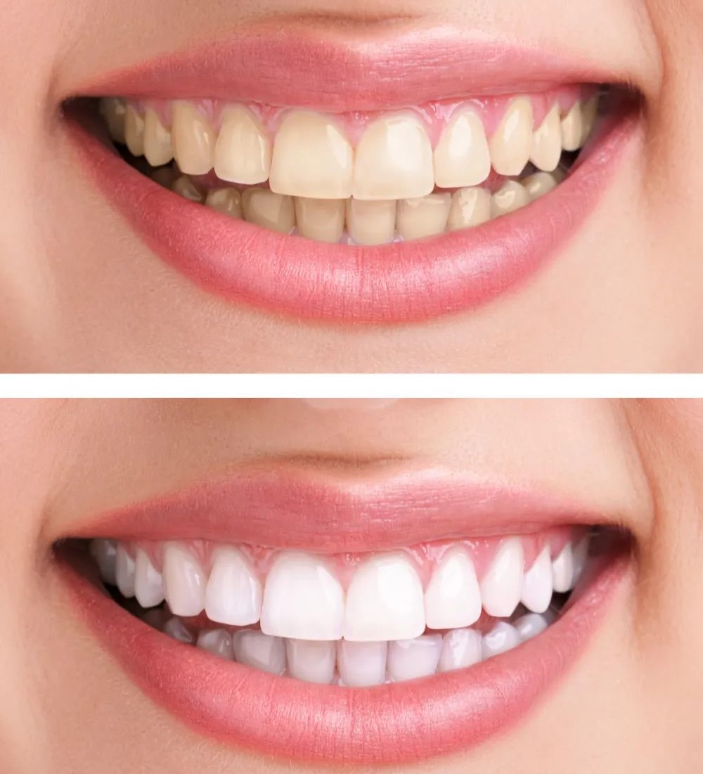 洗牙和牙齿美白是两回事！