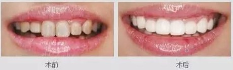 洗牙和牙齿美白是两回事！