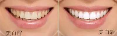 洗牙和牙齿美白是两回事！