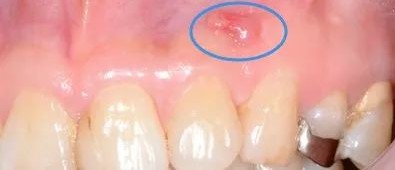 牙龈上长脓包，挤掉后还反复长出怎么回事？